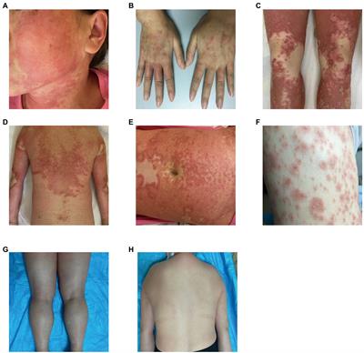 Clinical features of acute generalized exanthematous pustulosis caused by hydroxychloroquine in rheumatology patients and exploration of CARD14 gene mutations